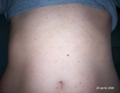 pytiriasis
